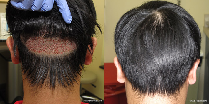 Un-Shaven Hair Transplant